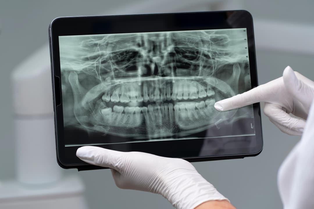 OPG Dental Scan